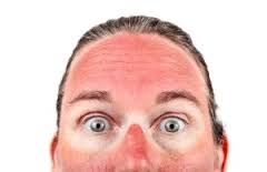 Слънчево изгаряне лице