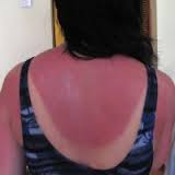 Слънчево изгаряне гръб