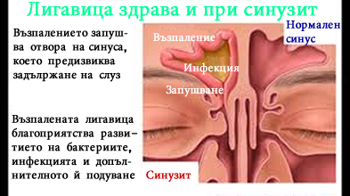 Тъканни промени при синузит Здрави синуси и синусите при синузит