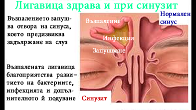 Здрави синуси и синусите при синузит